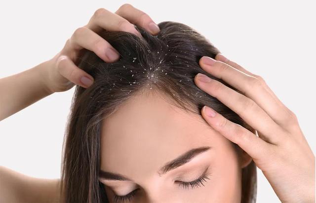 Home remedies For Dandruff By Urban Culture