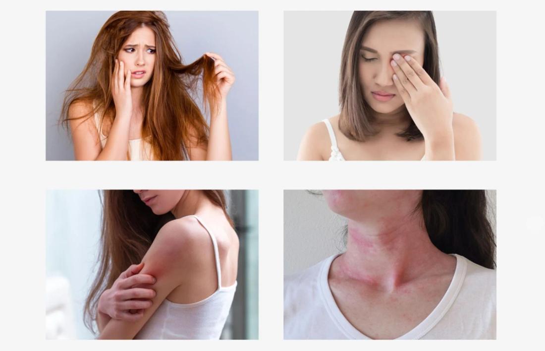 Different side effects of hair dye : irritation in eyes, dry hair, Rashes on skin