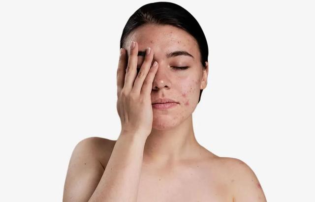 Oily acne prone skin