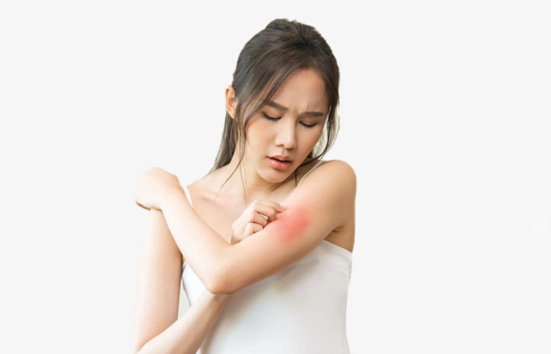A Woman Allergic Rash on bicep